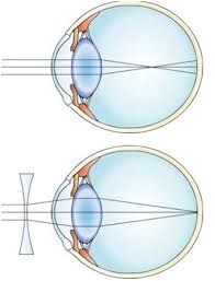 Check spelling or type a new query. Soal Fisika Mengenai Cacat Mata Jawabanku Id