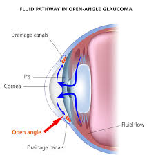 An abnormality in the eye's drainage system can cause fluid to build up, leading to excessive pressure that causes damage to the optic nerve. Types Of Glaucoma Glaucoma Research Foundation