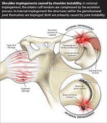 In this context, we refer to structures within the this diagram shows how all of the components of the shoulder come together during throwing, with the red star indicating the point at which the rotator cuff. Shoulder Impingement Syndrome Decompression Surgery What Are Your Alternatives Caring Medical Florida