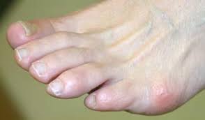 Ganglion cysts and other soft lumps on top of the foot. Bunions Joshua Kaye Dpm