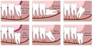 Complex extractions run as much as $500 per tooth. Surgical Removal Of Wisdom Teeth Gold Coast Oral Maxillofacial Implant Surgery