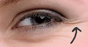 Goz Cevresi Kaz Ayagi Kirisikliklari Kirisiklik Gen Tr