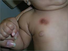 Image result for Urticaria pigmentosa children