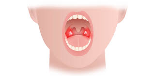 Maybe you would like to learn more about one of these? Mandelentzundung Krankheiten A Z Medgate
