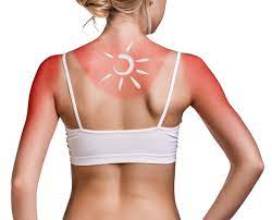 Factorii de risc pentru arsurile solare tratamentul la domiciliu al arsurilor solare arsurile de gradul ii sunt insa leziuni mai profunde, mai dureroase si care necesita un timp mai. Remedii Pentru Arsuri Solare Care Functioneaza Conform Specialistilor
