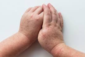 Si manifesta con sintomi come: Scarlattina 3 Consigli Alle Mamme Deabyday