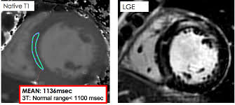 Cardiac magnetic resonance (mr) is currently the preferred imaging modality for the diagnosis of myocarditis. Cmr Indications