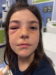 Isaiah's infected tear duct diagnosis and hospital treatment