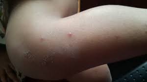 Ketika saya perasan saya dah dijangkiti oleh chicken pox, isteri saya mula memberi vitamin shaklee untuk saya makan. Damia Dan Chicken Pox Cp Life S Like That