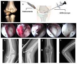 Image result for Lateral Condyle Fracture