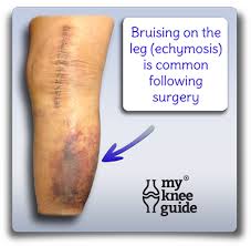 The Wound Important Considerations To Understand Knee Replacement Recovery Knee Replacement Knee Replacement Surgery
