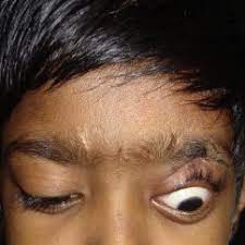 Lid lag, von graefe's sign, stare, and lagophthalmos can be useful eyelid findings when lid lag and stare, however, are believed to be caused by excess thyroid hormone and. Photograph Showing Lid Lag In Downgaze Download Scientific Diagram