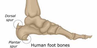 A bone spur in the wrist usually means the outgrowth is on the surface of the wrist bone. Heel Spurs The Foot Care Group