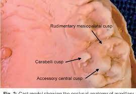 The mesiopalatal cusp has a triangular ridge which descends directly into the central fossa. Figure 2 From Accessory Central Cusp In The Maxillary Second Primary Molars A Rare Entity Among The Rare Semantic Scholar