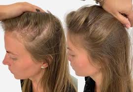 When it affects women, it is called female pattern alopecia or female pattern baldness. Hair Loss In Women Female Hair Loss Treatment Birmingham
