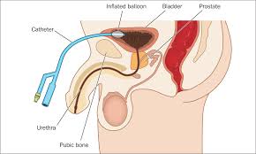 Image result for Bladder Irrigation