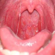 What is the potential of hpv vaccines for primary prevention? New Risk Factor For Head Neck Cancers And How It Could Impact Screening And Diagnosis Wrvo Public Media