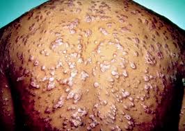 Image result for niaid secondary syphilis