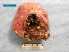 Check spelling or type a new query. 11 Teratoma Ideas Dermoid Cyst Ovaries Dermoid Ovarian Cyst