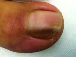 Wichtige Maligne Und Neue Nageltumoren Haneke 2017 Jddg Journal Der Deutschen Dermatologischen Gesellschaft Wiley Online Library