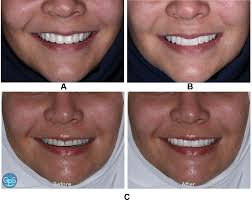 Conventional and Digital Workflow Planning for Maxillary Teeth Restoration  with Porcelain Laminate Veneers: A Clinical Report