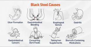 Image result for dark black stool human poop