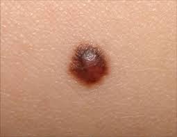 Image result for Spitz Nevus