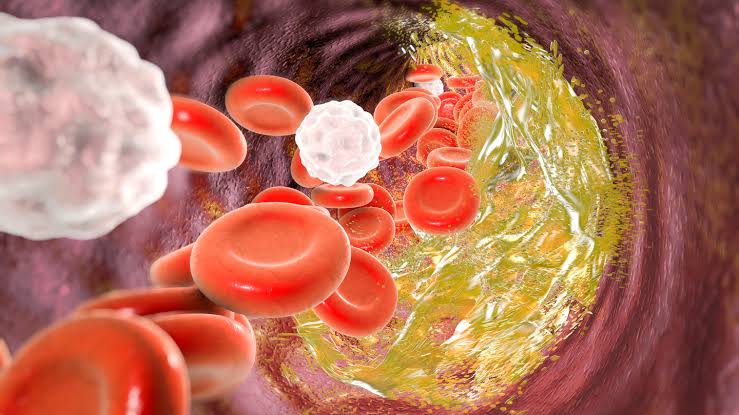 A gene editing technique shows promise for lowering LDL cholesterol