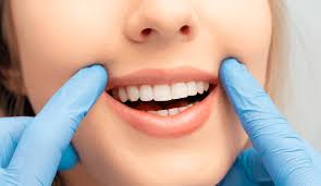 How Old Do You Need to Be For Teeth Whitening?