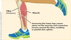 Image result for Shin Splints