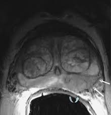 Advertisement from conditions to treatments to surgical devices and more, we've put everything you need to kno. Mr Imaging In Local Staging Of Prostate Cancer European Journal Of Radiology