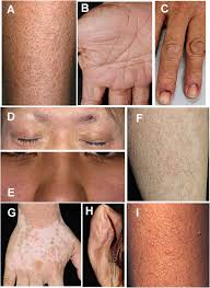 Image result for Ichthyosis