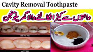 The only sure method to remove a cavity and keep it. Tooth Care In Urdu Hindi Homemade Cavity Removal Toothpaste Anam Home Remedy Youtube