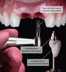 Image result for dental implant