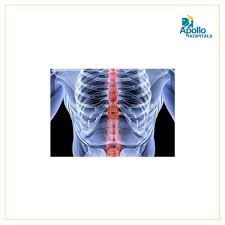 A sudden sprain or strain (as in car accidents or sports injuries). What Exactly Is Minimal Lower Thoracic Spine Spondylosis Apollo Mumbai Blog