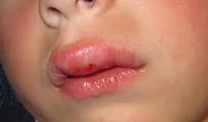 Punca bibir kering dan bengkak. Penyebab Bibir Bengkak Rawatan Cepat