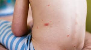 Penyebab cacar air adalah virus varicella zoster yang menyerang kulit penderita. Cacar Air Pengertian Gejala Penyebab Faktor Risiko Diagnosis Pengobatan Dan Efek Samping Pencegahan Kapan Harus Ke Dokter Halodoc Com