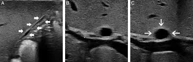 We did not find results for: Ultrasound Evaluation Of Biliary Atresia Based On Gallbladder Classification Is 4 Hours Of Fasting Necessary Zhou 2019 Journal Of Ultrasound In Medicine Wiley Online Library