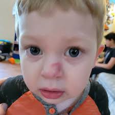 dog bites owner's nose