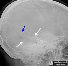 Wormian Bones Multiple Accessory Bones White And Blue Arrows Are Seen Within The Lambdoid Suture Of The Skull Characteristic Of Wor Radiology X Ray Medical