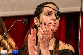 Dopo le mie parole a sanremo rimini, gessica notaro operata all'occhio: Gessica Il Coraggio Di Rinascere Dopo Lo Sfregio Laives Alto Adige