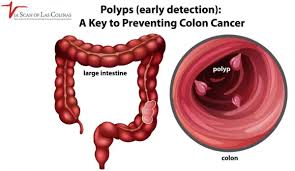 Image result for Colonic Polyp