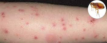 Como Identificar Picadas De Insetos Ponto Biologia