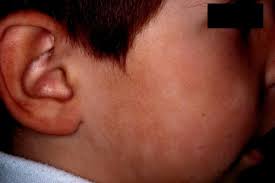 Pityriasis refers to the characteristic fine scale, and alba to its pale colour (hypopigmentation). Pityriasis Alba