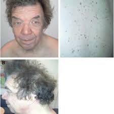 Photograph of the affected father with the same NRAS mutation, p.G60E....