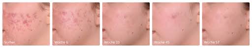 Check spelling or type a new query. Aknebehandlung Vorher Nachherbilder Dr Med Natalie Keller Behandlung In Osnabruck