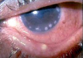 Evans, minjian ni, brigitte a. Keratitis Causes Symptoms Diagnosis Prevention Treatment