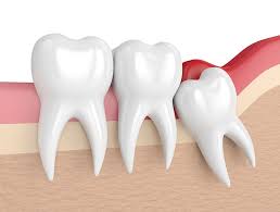 Dry socket can give you spikes of sharp pain coming out of the extraction site, as well as an unpleasant taste in your mouth. Wisdom Teeth Removal Mississauga Rockwest Dental Clinic