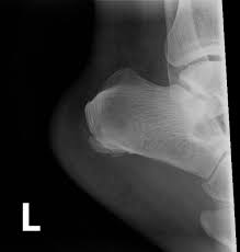 Image result for Calcaneus Compression Fracture