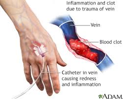 I felt pain and sore on my whole arm through the first and the second day. Superficial Thrombophlebitis Information Mount Sinai New York